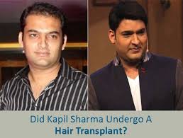 Difference in hair transplant results. Did Kapil Sharma Get A Hair Transplant Artius Hair Transplant