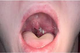 Get Strep Throat Treatment Online Callondoc