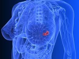 When breast cancer spreads to the liver it is common for women (and men) to experience generalized itching, which can be intense. Breast Cancer Symptoms Complications And Treatment