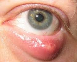 как лечить ячмень на нижнем веке в домашних условиях Kak Lechit Sozrevshij Yachmen Recept Poshagovyj S Foto