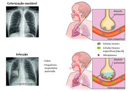 Pneumonia is a form of acute respiratory infection that is most commonly caused by viruses or bacteria. Vacina Contra Pneumonia Alternativa Aos Antibioticos