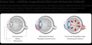 Gruner Star Grauer Star Amd Symptome Behandlung Wolfs Apotheke Bredstedt