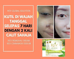 Inilah alasan mengapa tahi lalat umumnya berwarna hitam atau kecokelatan. Rawatan Hilang Tahi Lalat Kutil Ketuat Biji Kolesterol Home Facebook