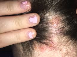 Discuss with your doctor or dermatologist any prescription emollients or creams that might help soothe your shingles rash or decrease itching to prevent scratching. Scalp Sores Glow Community