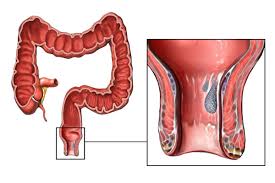 Image result for Rectal prolapse