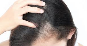 Since many black men tend to shave their hairline in a very straight line, dr. Losing Strands Get Natural Looking Results With Hair Transplant Surgery