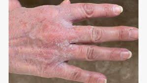 Image result for scabies symptoms