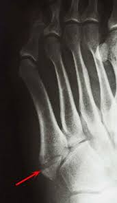 Metatarsal base fractures may occur in conjunction with lisfranc joint injuries, as described earlier. Toe And Forefoot Fractures Orthoinfo Aaos