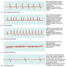 Paroxysmal Tachycardia - An Overview | Sciencedirect Topics