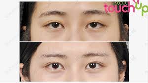 I am partly asian,i have almond shaped eyes and stretchy lids but i do not have a monolid or epicanthical fold as you can see. How Double Eyelid Surgery Has Become A Rite Of Passage For Many South Korean Youths I D