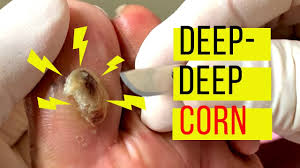 If you have an unsightly toenail fungus you need to get rid of, vicks vaporub is the thing you need. Toes Kim Holistic Foot Ankle Center