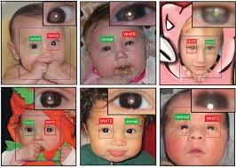 Children with underlying medical conditions are at increased risk for severe illness compared to children without underlying medical conditions. Smartphone App Can Help Detect Leukocoria A Sign Of Eye Cancer Shots Health News Npr
