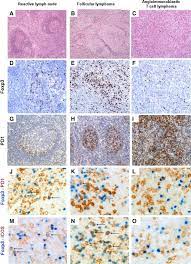 It is a systemic disease that presents with generalized lymphadenopathy, hepatosplenomegaly, constitutional symptoms, skin rash, anemia. Regulatory T Cell Depletion In Angioimmunoblastic T Cell Lymphoma Sciencedirect