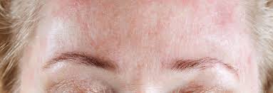 Image result for Seborrheic Dermatitis