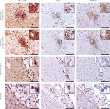 La cape et l'?p?e serie. Neuropathology Of Patients With Covid 19 In Germany A Post Mortem Case Series The Lancet Neurology