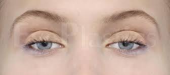 Fashion women glasses frame cheap prescription eyeglasses. Mark Brown Md Ptosis Surgery Droopy Eyelid Lazy Eyelid Acquired Ptosis Ongenital Ptosis Eyelid Surgery Eyelid Lift Eye Surgery
