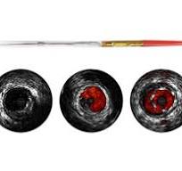 Philips Volcano - Eagle Eye Platinum ST Catéter digital IVUS ...