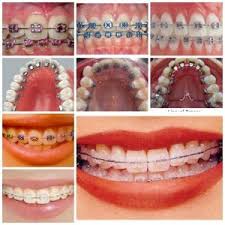 So, she decided to go in for round two to straighten her teeth. Braces Uk Types Of Braces For You Angel Orthodontics