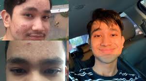 Ko tetap tidak melupakan pada golongan yang kurang bernasib baik. Dulu Muka Lelaki Ini Berjerawat Teruk Sampai Bernanah Berjaya Dapat Kulit Licin Lepas Buat Rawatan Ini