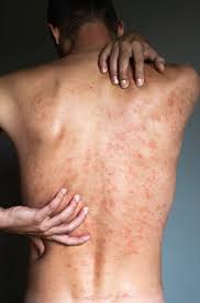 Image result for dermatitis contacta allergica