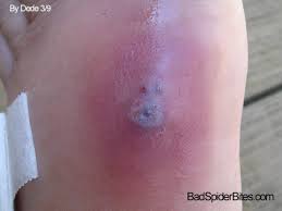 Ingrown facial hair removal can be some time be hectic and very complicated to some people. Staph Infection Badspiderbites Com