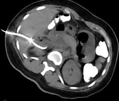 Image result for Perinephric Abscess