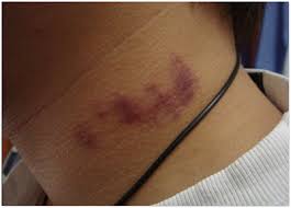 Tips Cara Menghilangkan Kesan Lebam Lovebite Love Bites Hickeys Kesan