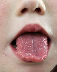 It was first identified in december 2019 in wuhan,. Kawasaki Disease Pediatrics Msd Manual Professional Edition