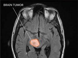 We did not find results for: Blood Test May Detect Genetic Changes In Brain Tumors National Cancer Institute