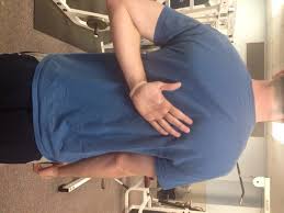 Image result for Winged Scapula