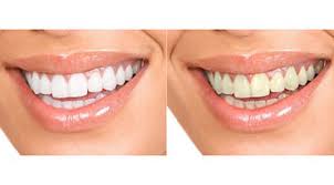 Blanchir Ses Dents Chez Dentiste Expert 2020