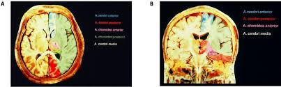 Arteria Cerebri Lexikon Der Neurowissenschaft