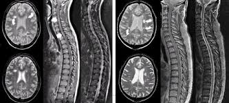 Magnetic resonance imaging (mri) is one of the most important and most commonly used tools for diagnosing and monitoring multiple sclerosis (ms). Esclerosis Multiple De Inicio Tardio I Medwave