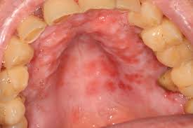 Image result for Oral herpes roof of mouth