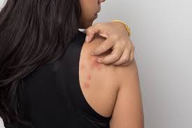 Maybe you would like to learn more about one of these? Ù…Ø±Ø¶ Ø§Ù„Ø´Ø±Ù‰ Urticaria E3arabi Ø¥ÙŠ Ø¹Ø±Ø¨ÙŠ
