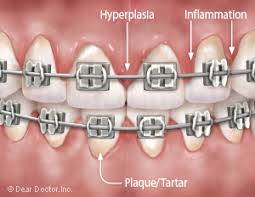 Healthy gums have a light pink colour and a smooth surface. Gum Swelling During Orthodontics