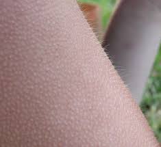 Goose bumps - Wikipedia
