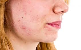 The two most effective ways to use vitamin a to treat acne are through nutrition and medications. Vitamin B5 Everything You Need To Know