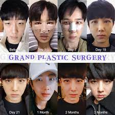 Make A Great Look Like An Idol Star Grand Is Here For You For Free Consultation Tel 82 Plastic Surgery Gone Wrong Plastic Surgery Fail Plastic Surgery