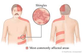 You want to be protected but you don't want to pay for superfluous or redundant coverage. Shingrix The New Shingles Vaccine Sona Pharmacy Clinic