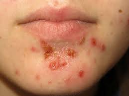 Image result for yellow scabs on the face in children
