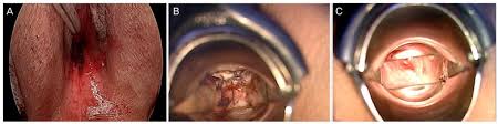 See research paper with world map showing prevalence.) A Successful Laparoscopic Neovaginoplasty Using Peritoneum In Mullerian Agenesis With Inguinal Ovaries Accompanied By Primary Ovarian Insufficiency