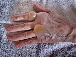 4 093 Burnt Hand Stock Photos Pictures Royalty Free Images Istock