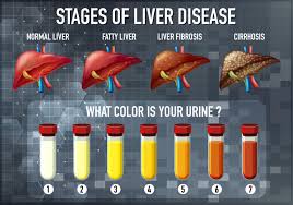 Cirrhosis of the liver is a chronic disease that causes cell destruction and fibrosis (scarring) of hepatic tissues. Liver Disease Educational Diagram Download Free Vectors Clipart Graphics Vector Art