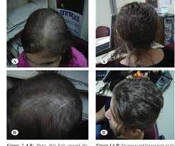 I'm taking cellcept and i asked my rheumi if i could take biotin and she said no. Pdf Mycophenolate Associated Alopecia In An Adolescent Girl Mycophenolate And Alopecia Semantic Scholar