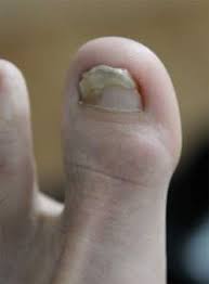 ausgefallener zehnagel wachst nicht schon nach