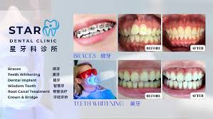 Star Dental Clinic Bukit Mertajam - Implant & Braces Centre 大山脚星牙科 种植牙和绑牙中心