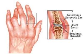 Isirgan Otu Kiraz Sapi Kuru Ile Iltihapli Eklem Romatizmasi Tedavisi Rheumatoid Arthritis Diet Rheumatoid Arthritis Arthritis Remedies