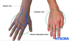 Image result for Peripheral IV Access