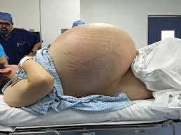 An infant with stomach ache can have poor feeding, lethargy, irritability and fussiness. This Woman Looked Pregnant But Actually Had Biggest Cyst In Her Womb